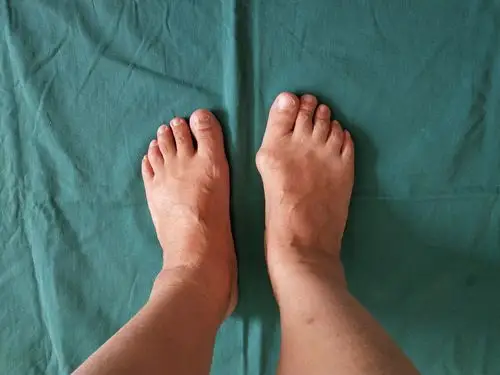 拇外翻术前术后术后比较 - 好大夫在线