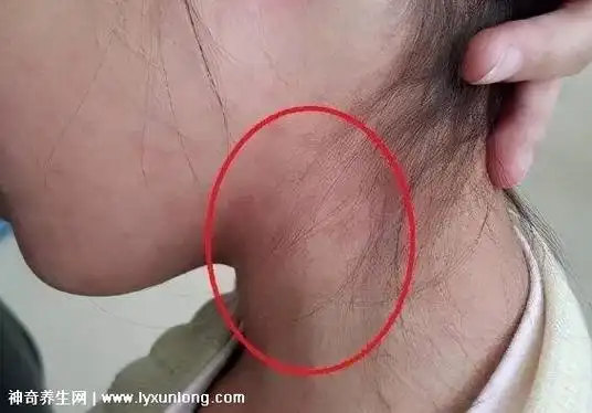 颈部淋巴结肿大图片症状侧面位置会有肿物伴随疼痛感要重视