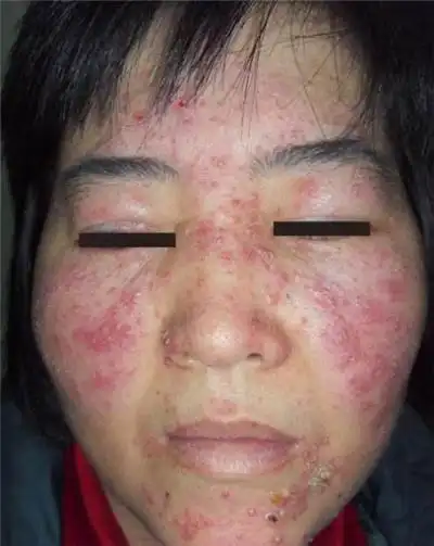 血热的症状痘痘图片8