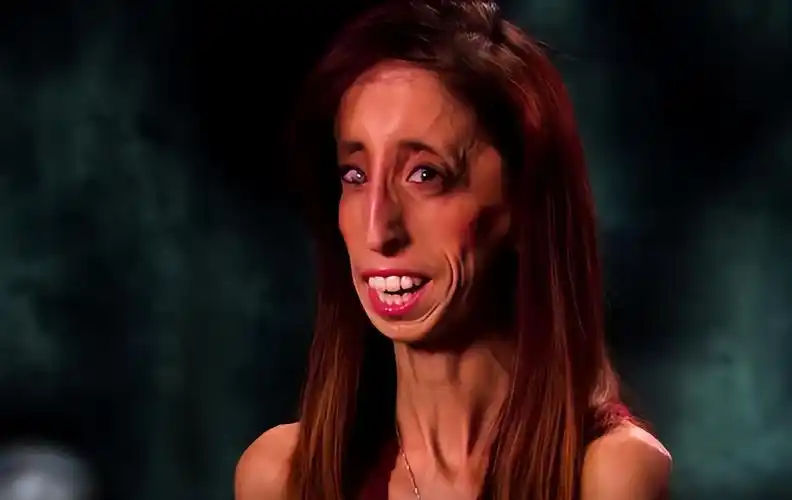 世界上最瘦的人现在怎么样(网红"骷髅女孩"体重仅27公斤,每天吃60顿饭