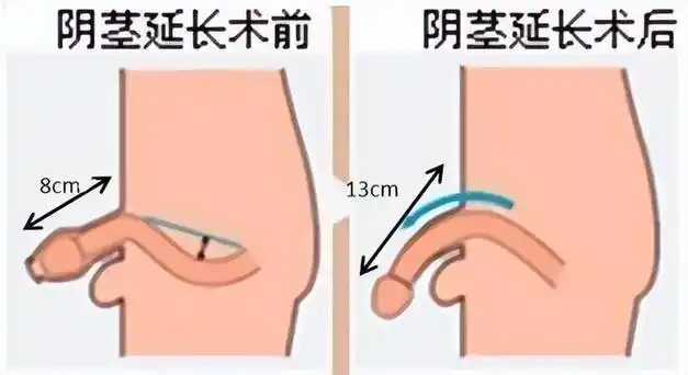 相比于普通包皮环切手术,该手术的风险更高.