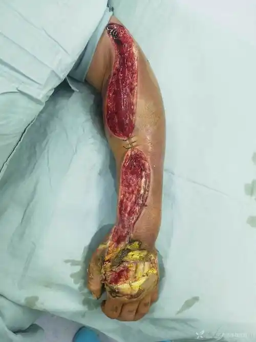 蛇咬伤皮肤皮下组织坏死治疗分享