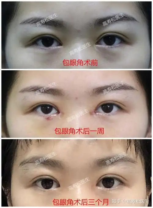 包眼角案例二个