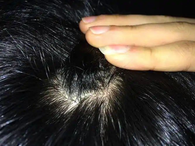 头发发根起小水泡是热症吗?是热症要怎么治疗?