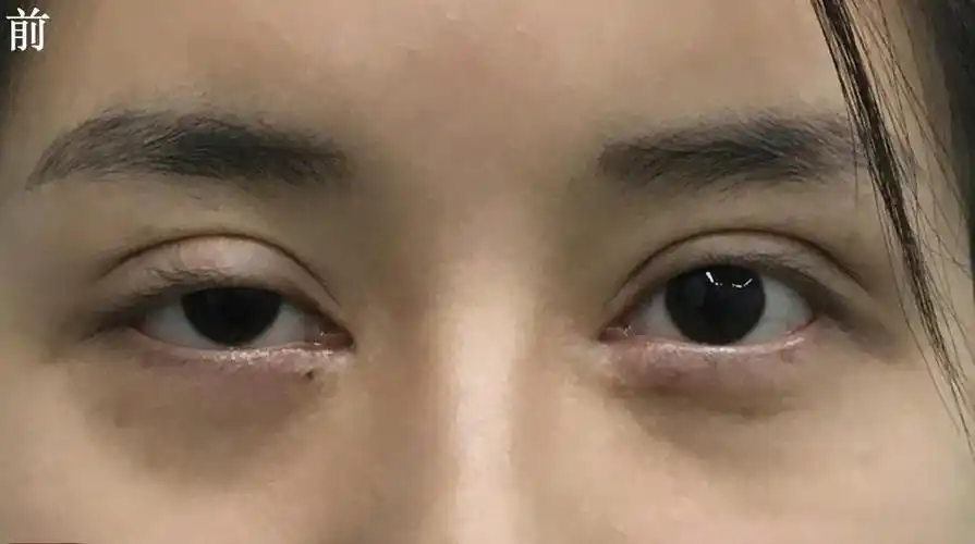 23岁女孩双眼皮失败,形态怪异,修复后重现迷人双眸!