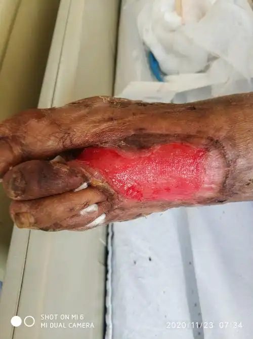 中药外用愈合外伤撕裂性伤口一例