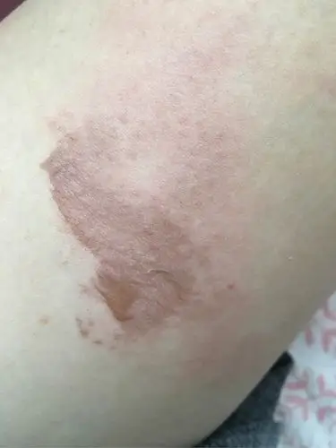 不小心将稀饭洒腿上了烫了泡怎么处理