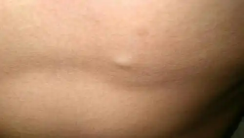 左胸口下方,长了小硬包.摸起来硬硬的无法移动.