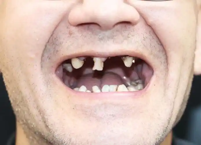 牙齿_种植体_老年人