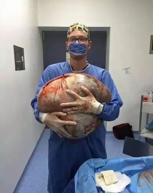 这个巨大的卵巢肿瘤是良性的还是恶性的呢