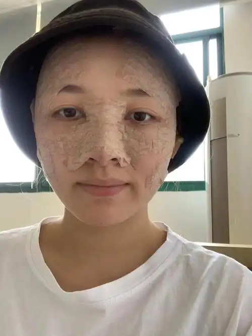 自体脂肪填充全脸第三天;刚做完那会肿胀是真的严重,现在已经好了很多