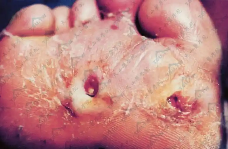 于足跖骨突起及身体重力压迫处,溃疡深,深部组织坏死,溃疡边缘角质