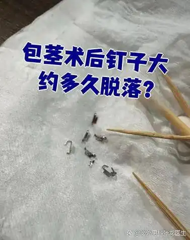 包茎手术后钉子通常会在两周左右脱落