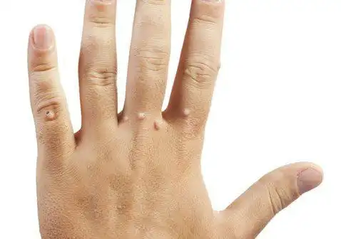 疣是什么样子图片及部位-阅荐养生网