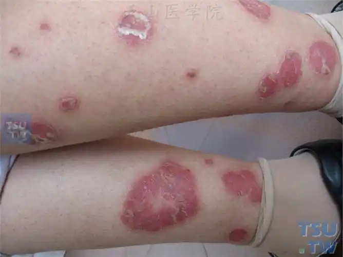 寻常型银屑病psoriasisvulgaris的症状表现