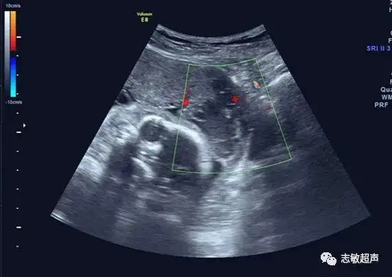 胎盘的下缘为血窦时