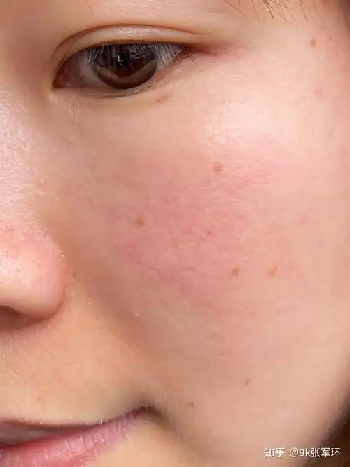 角质层薄,皮肤屏障受损怎么修复? - 知乎