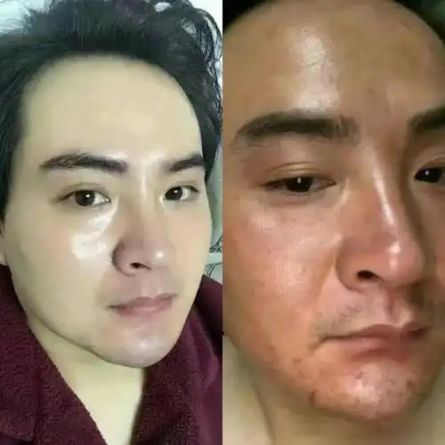 斑美拉提亮肤色 去掉黄气暗沉 皮肤细腻案例