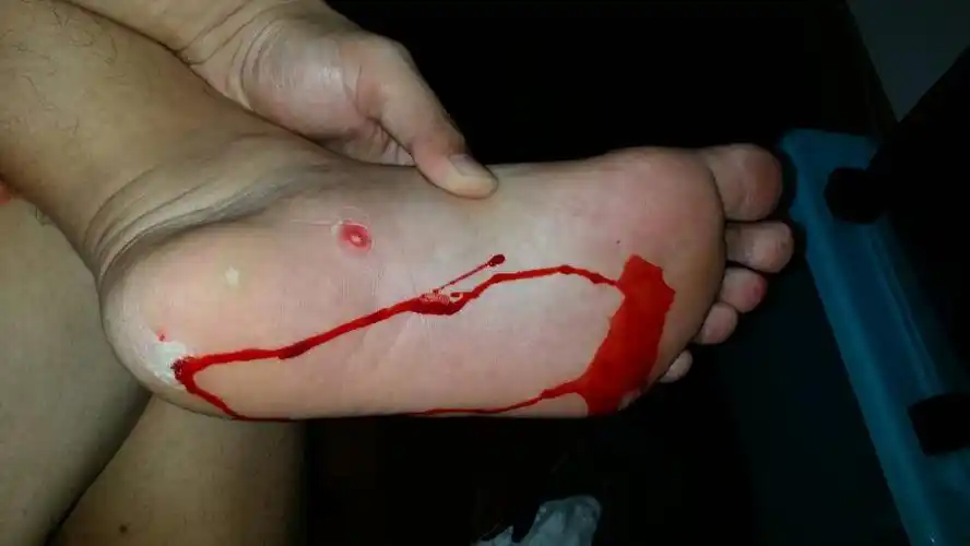 这样全是拔出鸡眼根了嘛