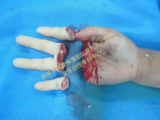 追求高质量---创伤性多指离断篇