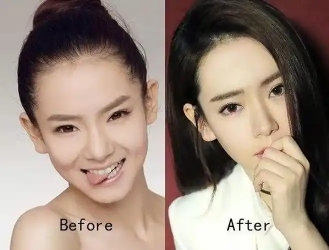 戚薇整容前后戚薇大胆承认自己割双眼皮