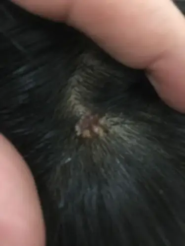 我儿子今年13岁前几天发现头上长了一个像菜花一样的肉瘤 不庝不瘥庠