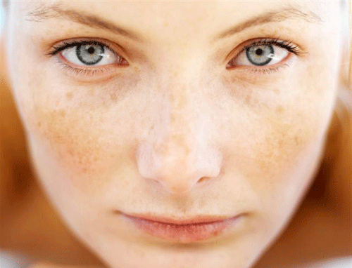 介绍几个常见斑(第一期)雀斑特点描述:浅棕色或褐色_圈子-新氧美容
