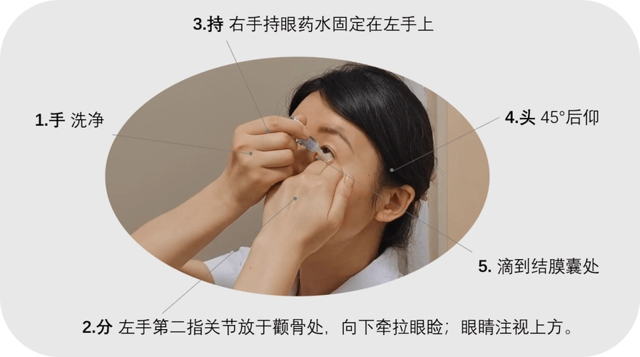 苦苦的啦~(2)眼膏●头后仰45°,拇指和食指轻轻拉开眼睑,眼睛注视上方