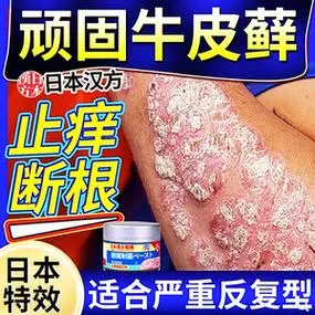 牛皮癣股藓过敏湿疹止痒根去皮肤专用特效正品杀菌药膏银屑病治