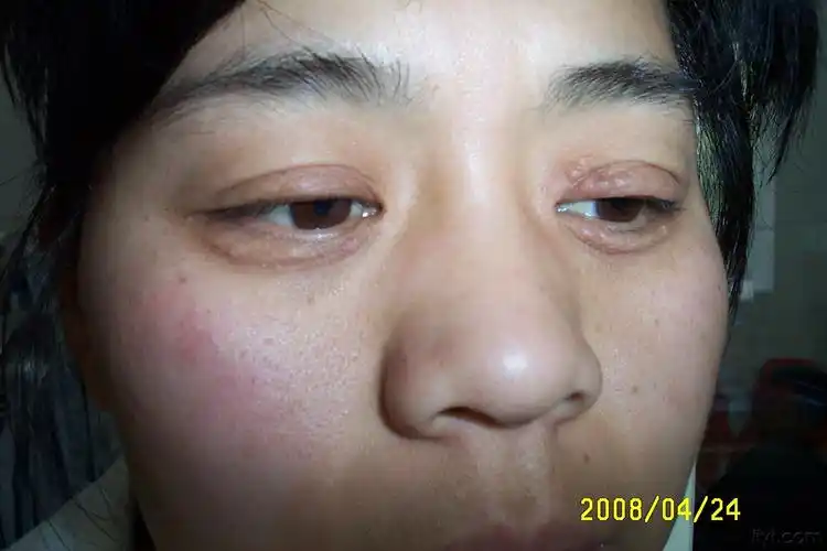眼睑皮疹10年余请会诊谢谢如图
