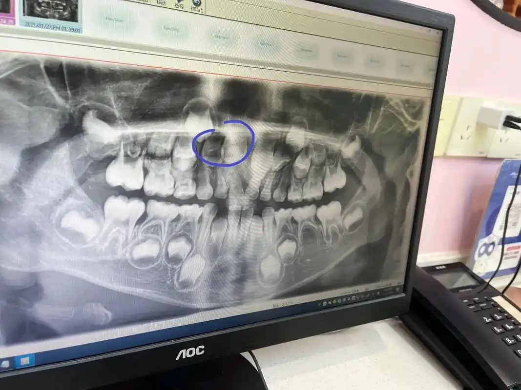 牙齿手术.#整牙历程 #牙齿矫正 #拔牙记 #掉牙的小孩 # - 抖音