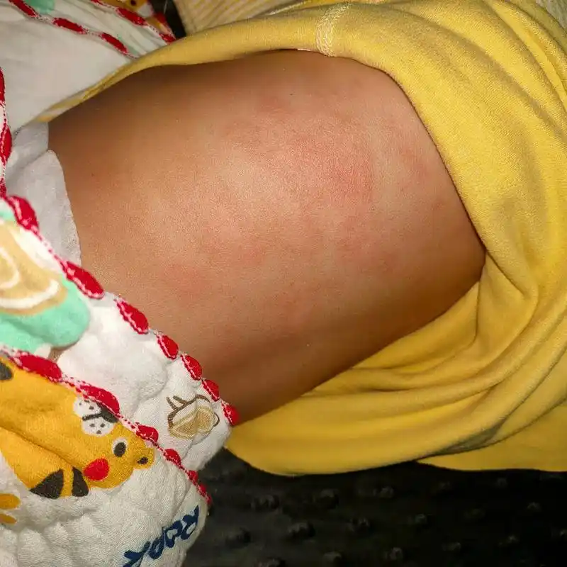 出生皮肤就湿疹严重,干燥起皮~现在又起这些是湿疹还是过敏啊, - 抖音