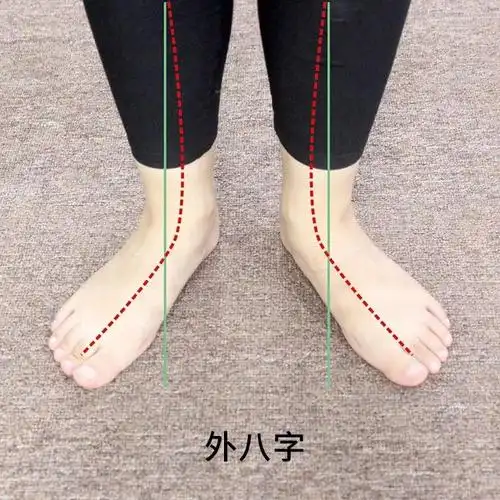 足脊健康知识小课堂第三期外八字篇