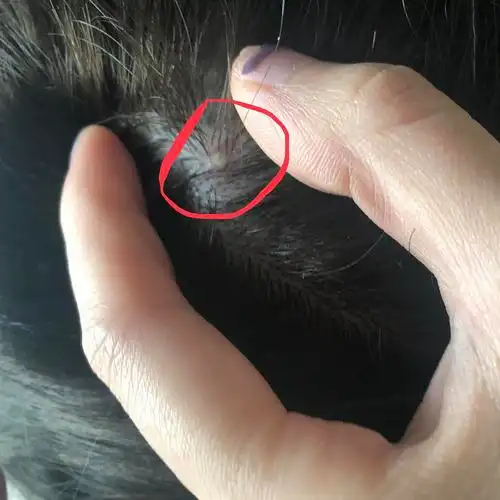 【慎入】头皮毛囊炎怎么办