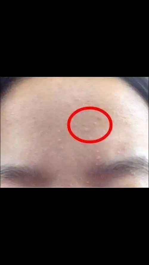 额头上长了好多小闭口,想知道怎么才能去掉?