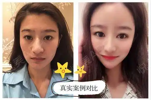 这才是全脸填充后效果的真实对比图