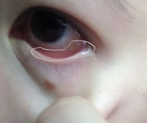 问:我的右眼下眼皮翻开时会发现接近褐色与红色的半