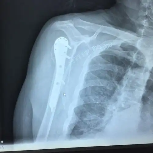 肩胛骨正侧位片与冈上肌出口位片投照要点*广东省中医院大学城运动