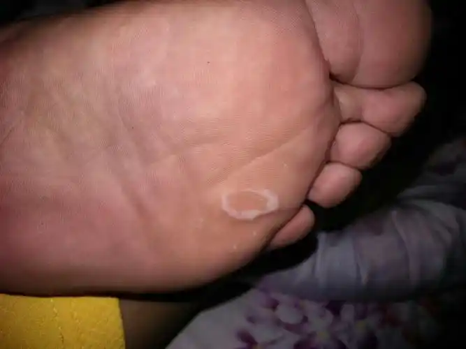 脚底每次泡脚之后都会起这个白泡,是怎么回事呀!要怎么治疗