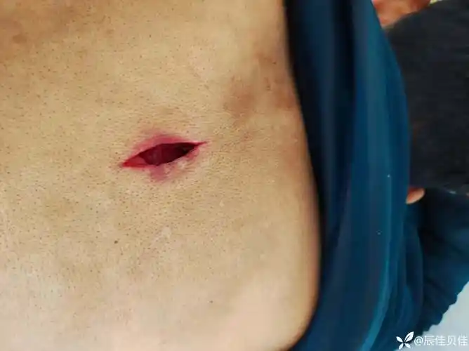 皮脂腺囊肿早期切开引流二期缝合经过