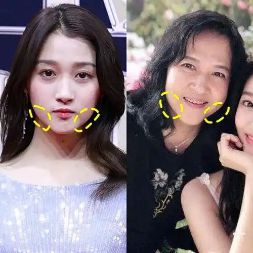 关晓彤有遗传性的口角囊袋下垂吗?