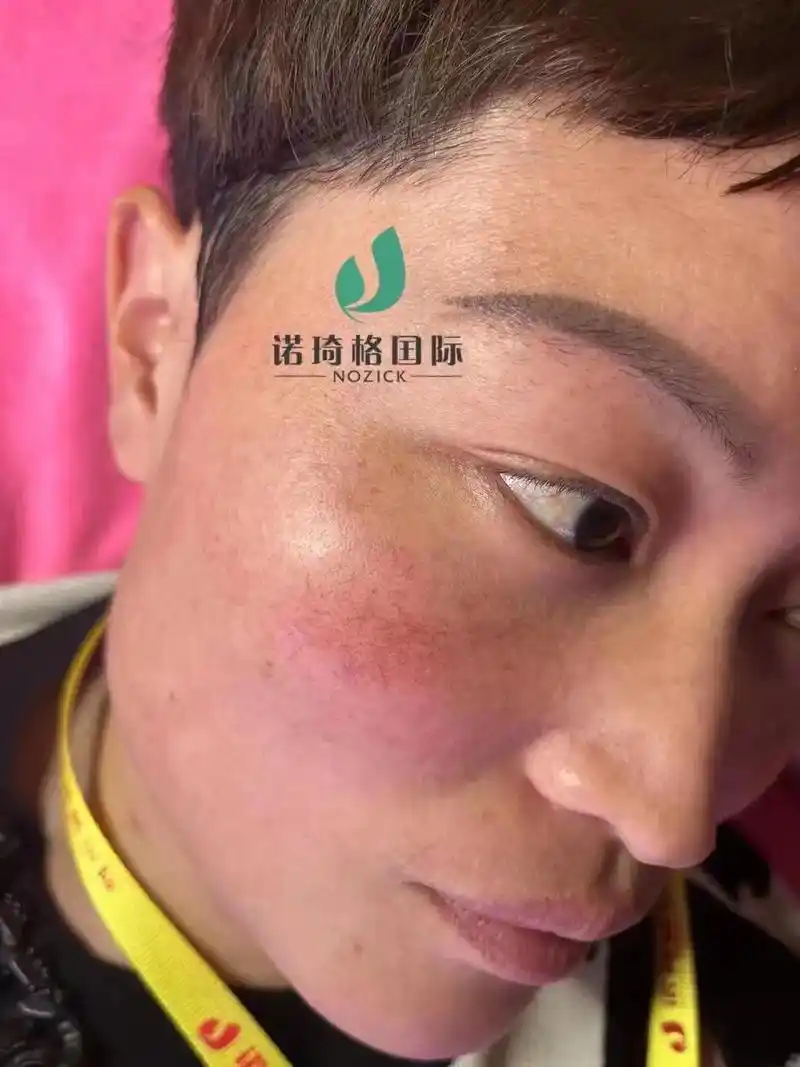 红血丝皮肤护理对比图,漂亮漂亮.#皮肤管理 - 抖音