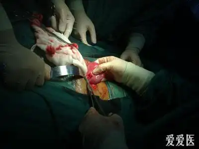 取环的取环后出血