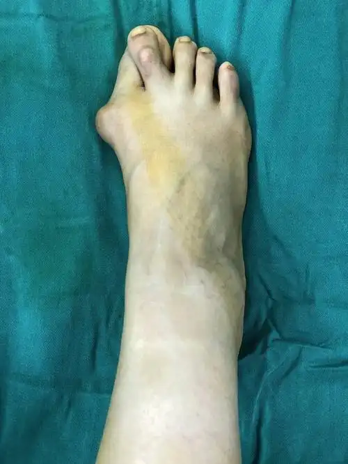 拇外翻交叉足趾矫形术 (原创)