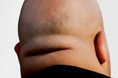 后脑横纹是后脑勺皮下组织存在大量脂肪,出现脂肪沉积,容易导致脑血管