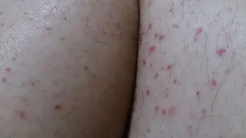艾滋病大腿上红点图片 (6)