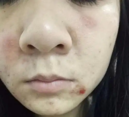 脸部湿疹最讨厌告诉你从外到内的湿疹治疗法大家都用