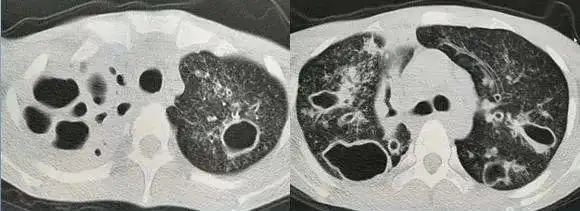 从ct上判断肺结核传染性的三种征象