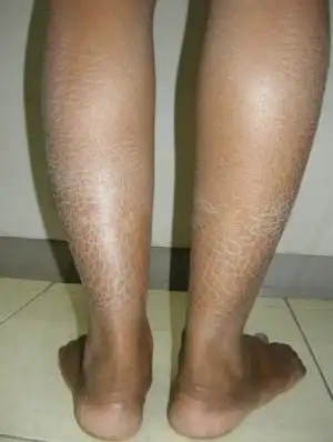 鱼鳞皮肤病的治疗方法,遗传性鱼鳞病吃什么药