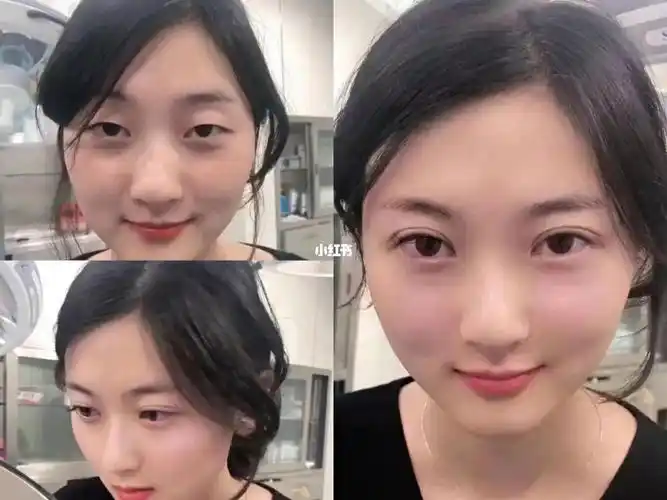 单眼皮不丑,但双眼皮更好看_双眼皮_单眼皮_双眼皮手术_全切双眼皮_医